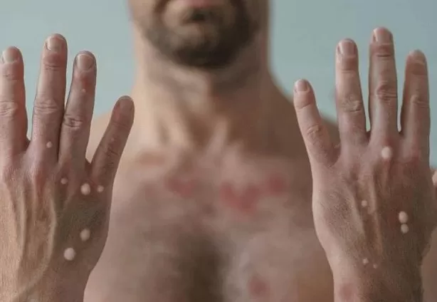 Ceará confirma o primeiro caso de Mpox em 2026, elevando o alerta sanitário