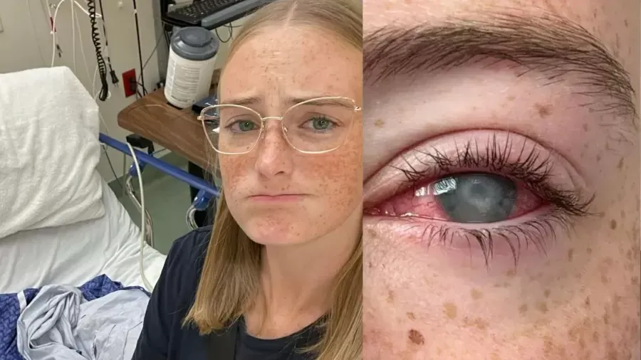 Jovem perde visão por hábito com lentes de contato