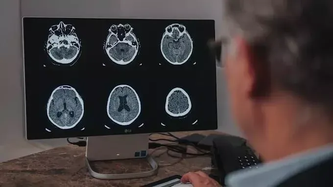 Maio Cinza Alerta para Câncer Cerebral e Diagnóstico Precoce