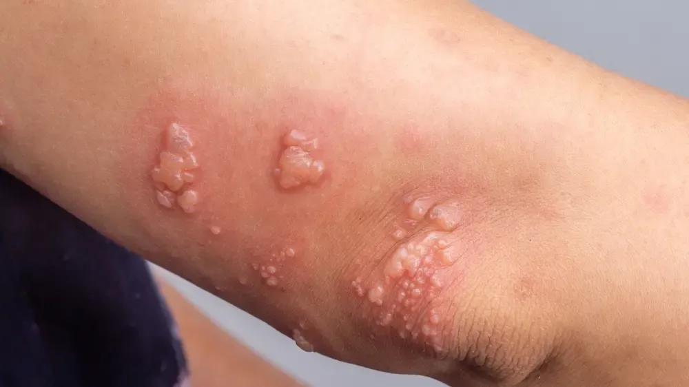 Vacina contra Herpes-Zóster em Fortaleza: Preços e Locais